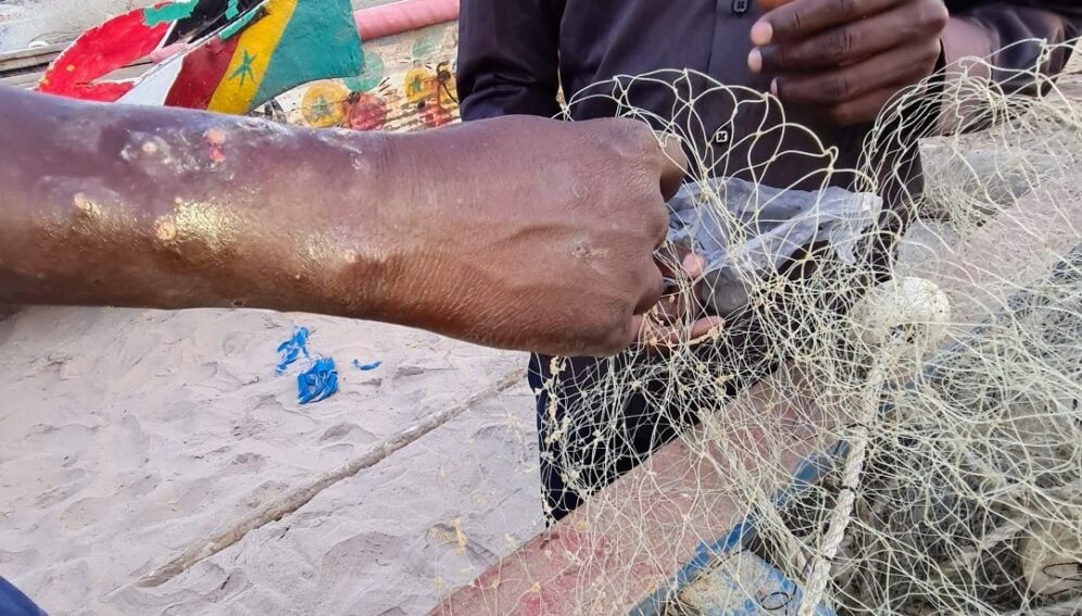 Fishermen disease in Senegal