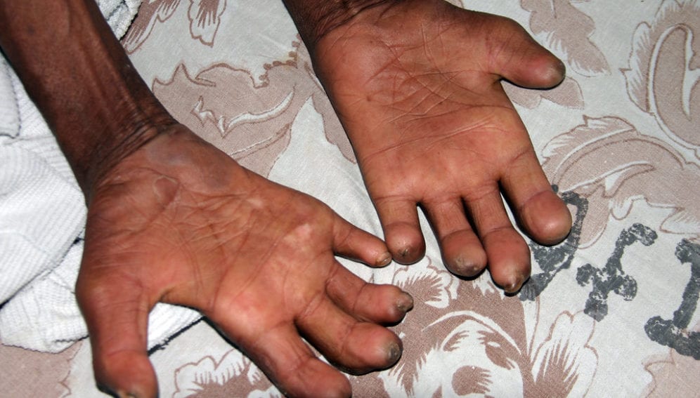 "Leprosy Patient" by ReSurge International is licensed under CC BY-NC-ND 2.0