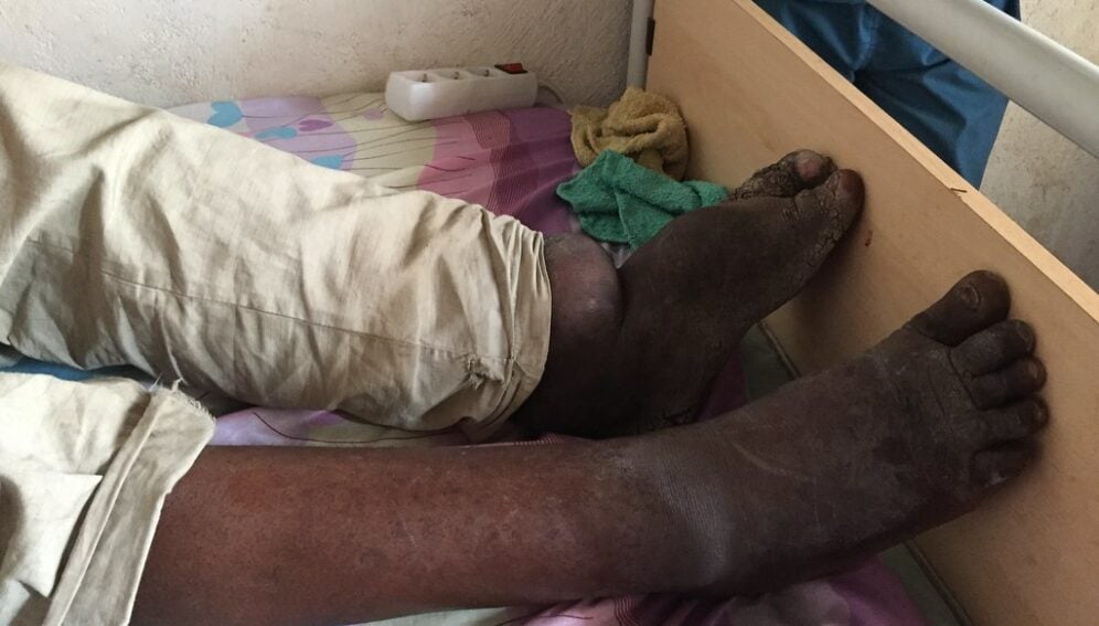 MTN Eléphantiasis