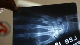 Rattan wood bone implants near human trials