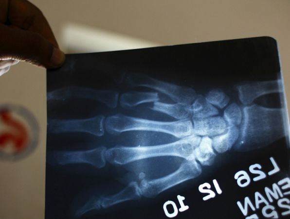 An x-ray of the broken finger