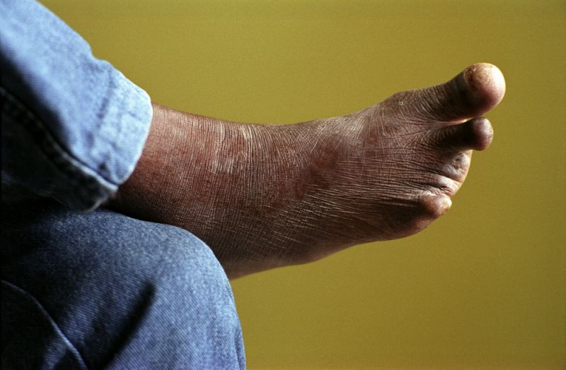 leprosy victim