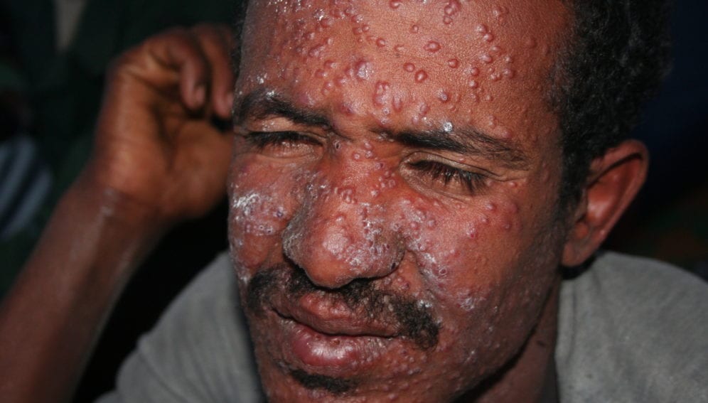 Patient_suffering from leishmaniasis