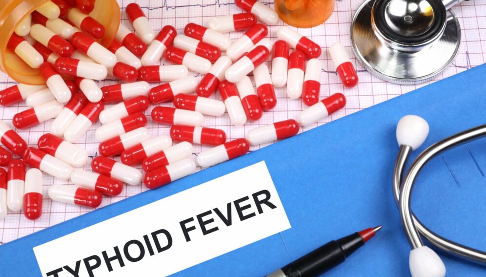 typhoid-fever