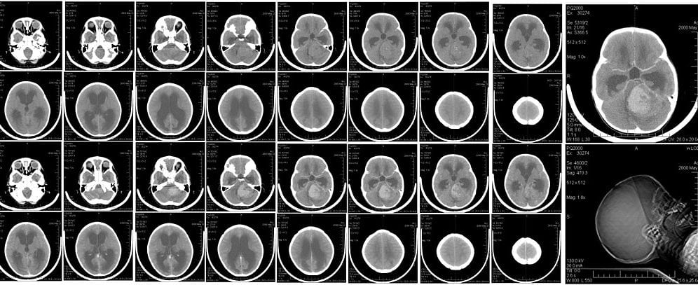 1024px-CT_brain_scan_of_child_with_medulloblastoma_and_resulting_hydrocephalus