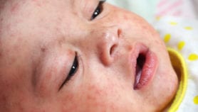 Philippines battles spike in measles cases