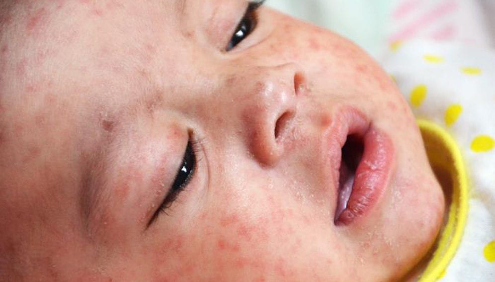 baby with measles-main