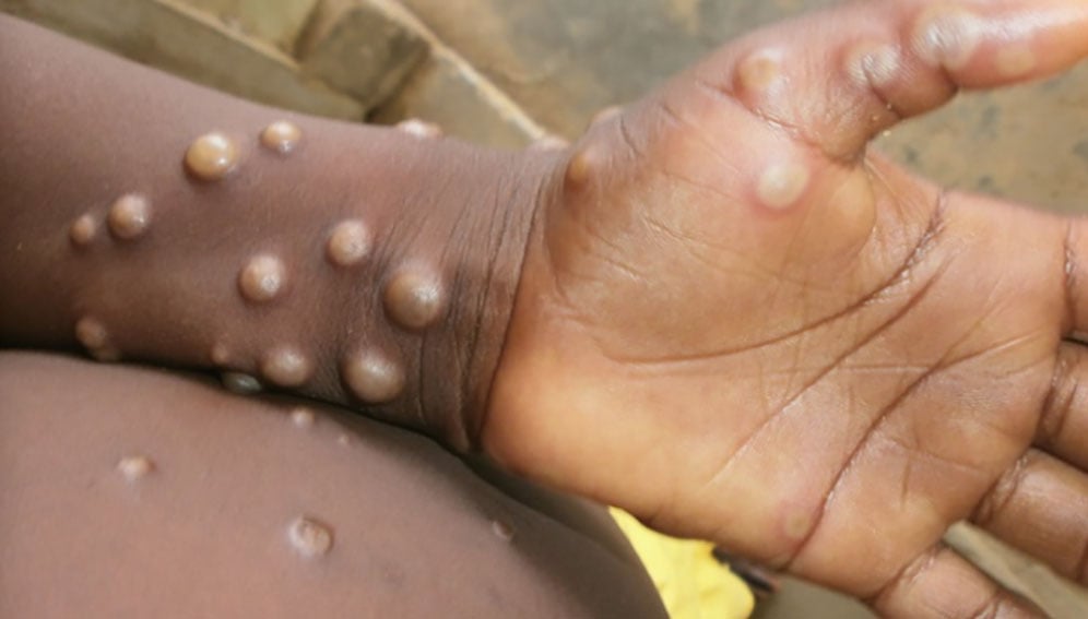 Mpox ‘blind spots’ in Nigeria