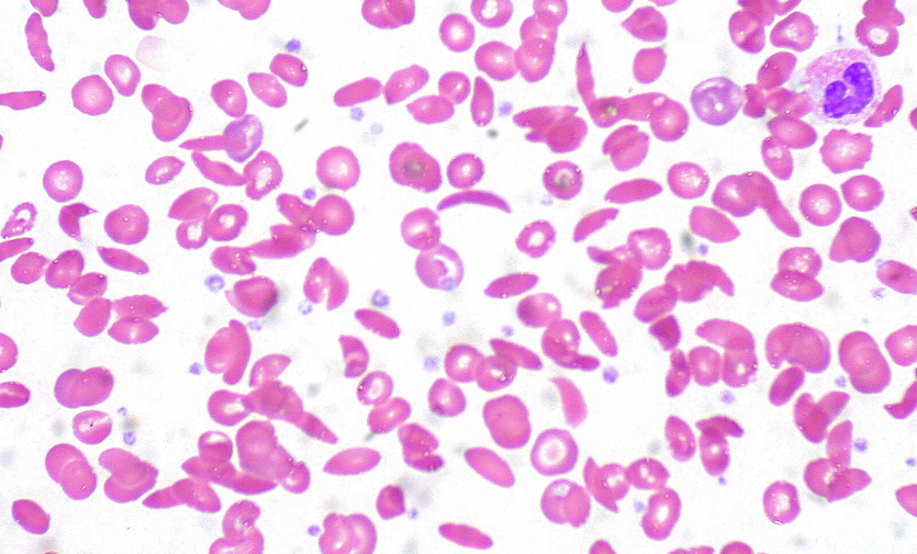 Sickle cell disease is caused by a mutation in the gene that produces haemoglobin, the protein that carries oxygen in red blood cells.
