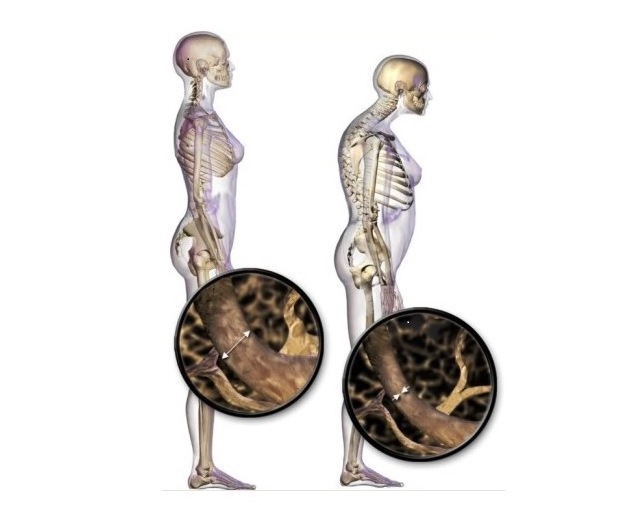 Osteoporosis  2222