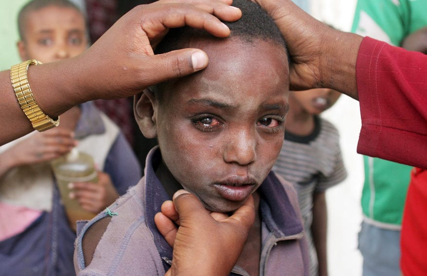 Bonsa-Lalenda, a 10yr old boy suffering from trachoma