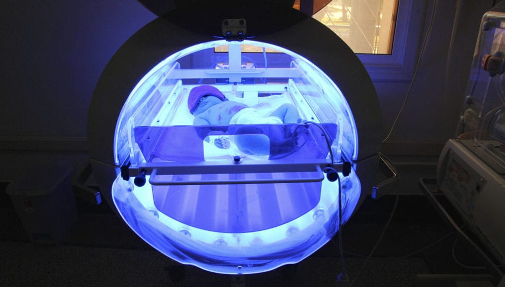 A premature baby receives UV treatment for bili lights