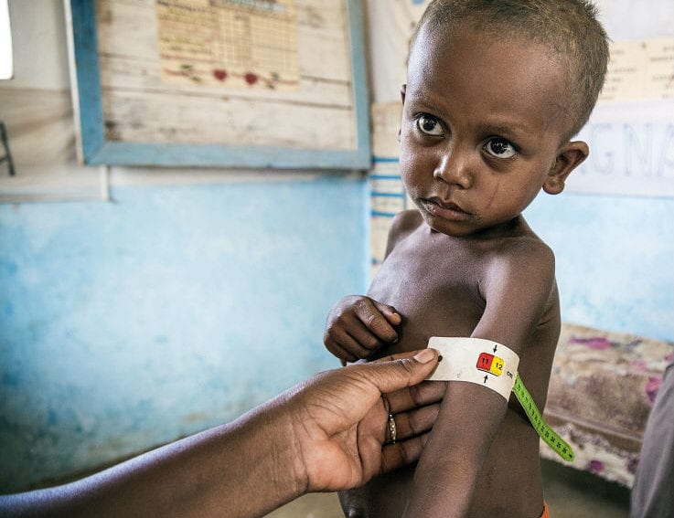 young boy suffering from malnutrition