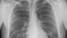 Simple lung screening method could save lives