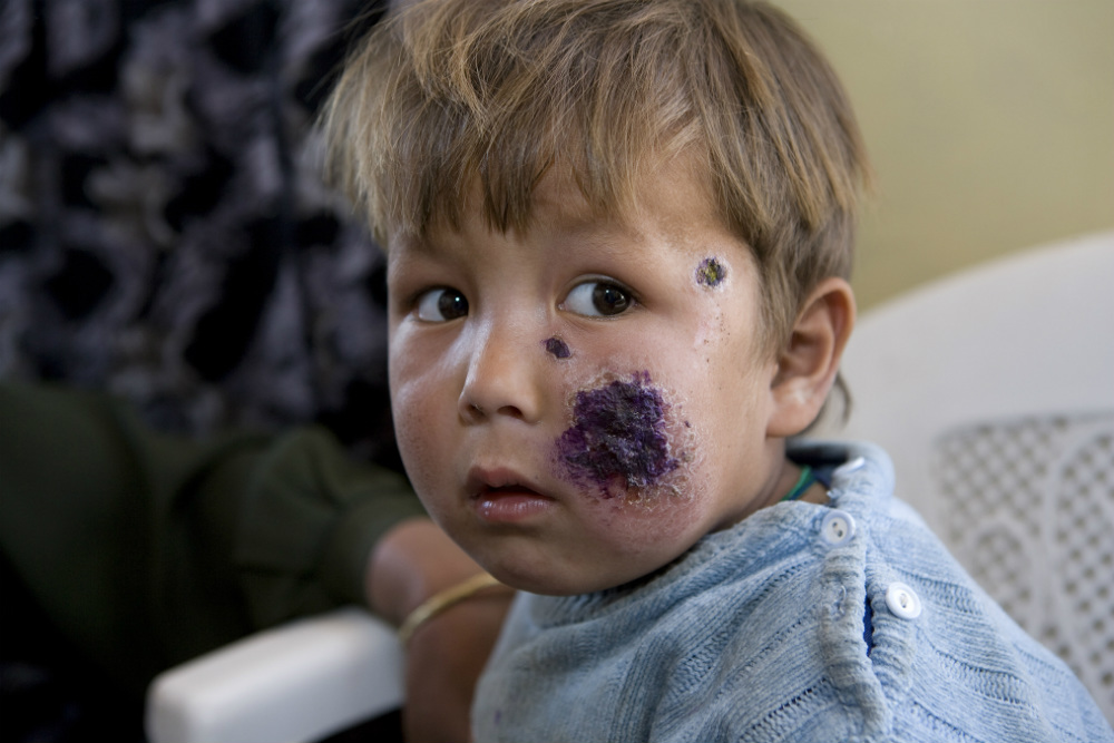 A girl at a clinic in Kabul, Afghanistan, with lesions on her face caused by cutaneous leishmaniasis. Exposed skin is more vulnerable to sand fly bites
