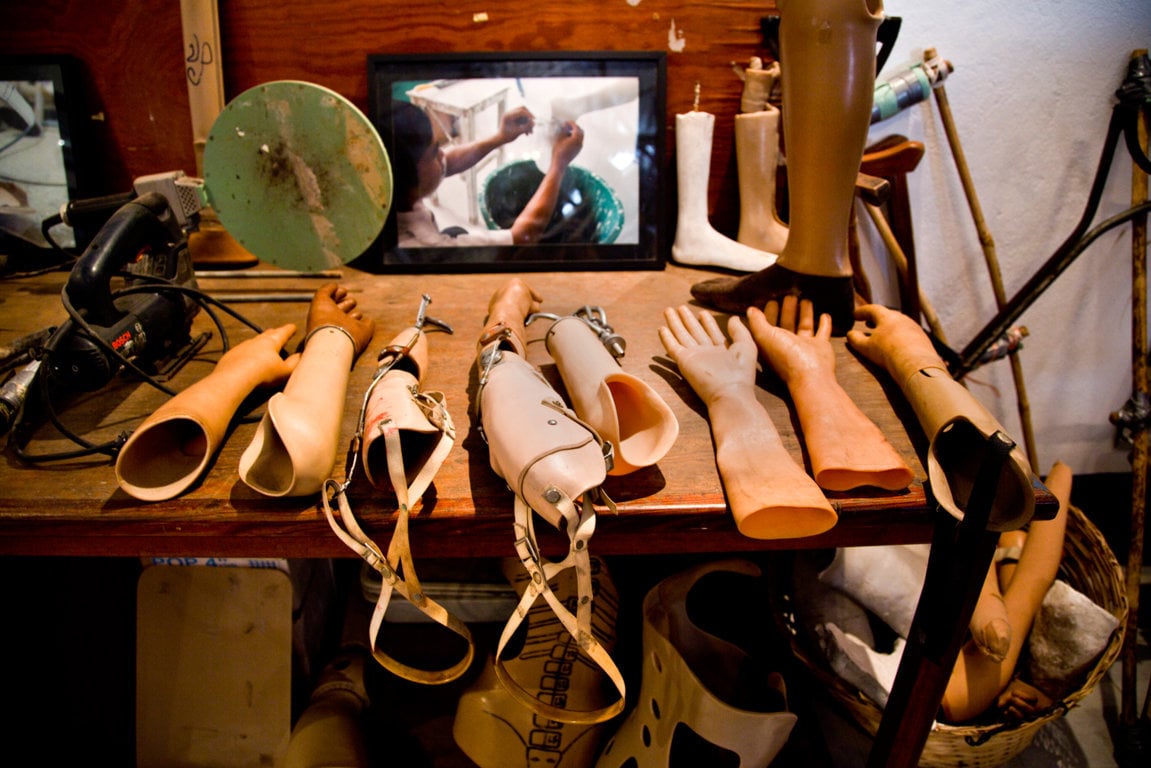 Various prostheses are available for those injured by unexploded ordnance 
