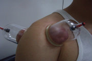 cupping therapy final